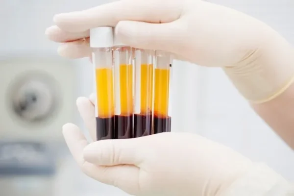 PRP (Platelet Rich Plasma)