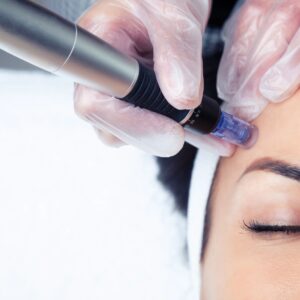 Microneedling Lexington