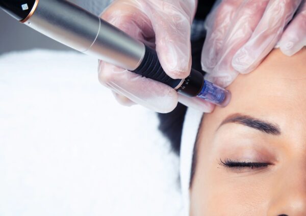 Microneedling Lexington