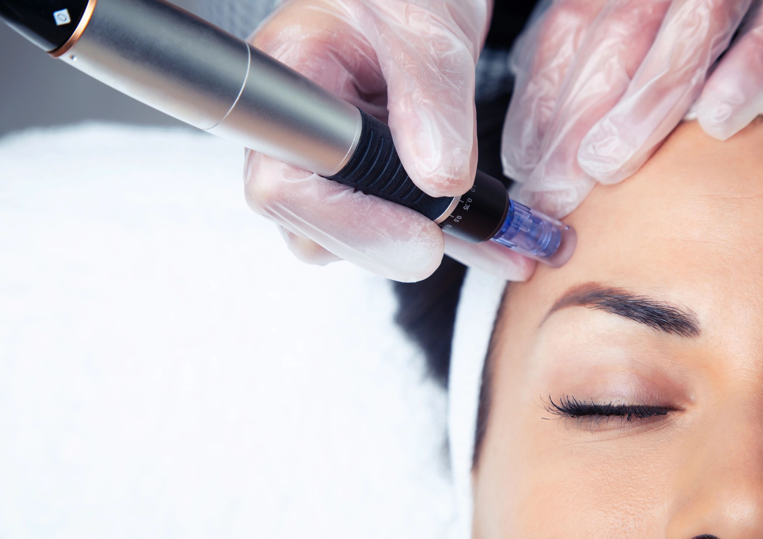 Microneedling Lexington
