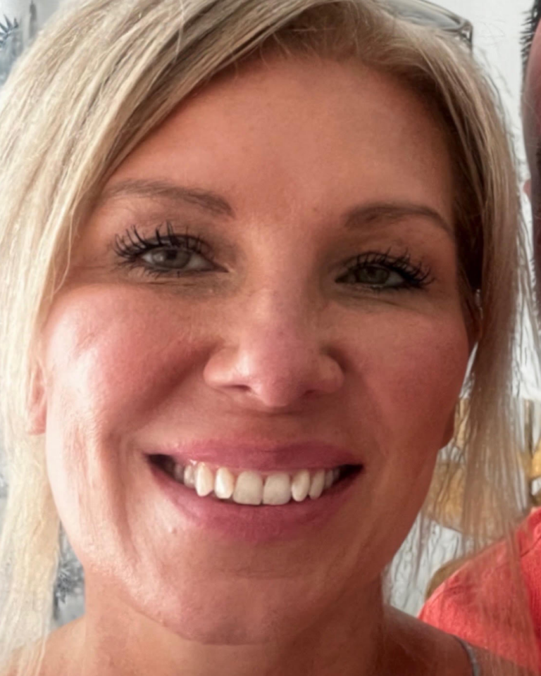 After patient - sculptra treatment