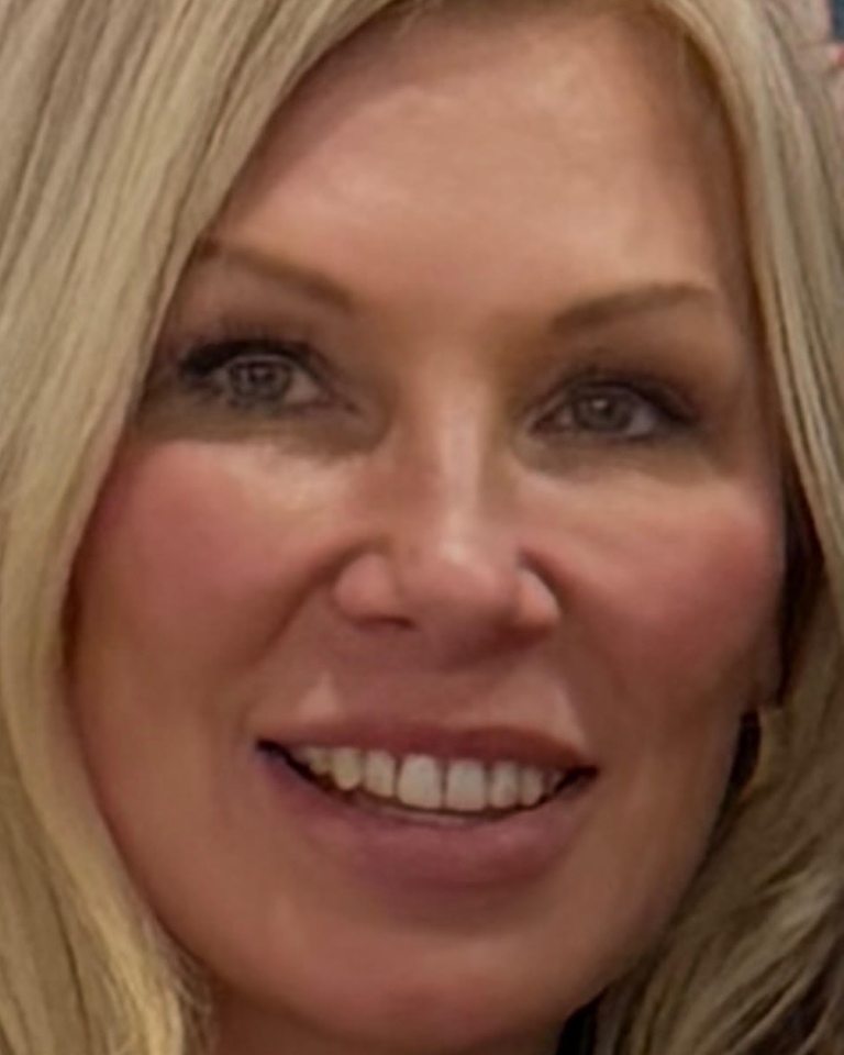 Patient After Sculptra Treatment