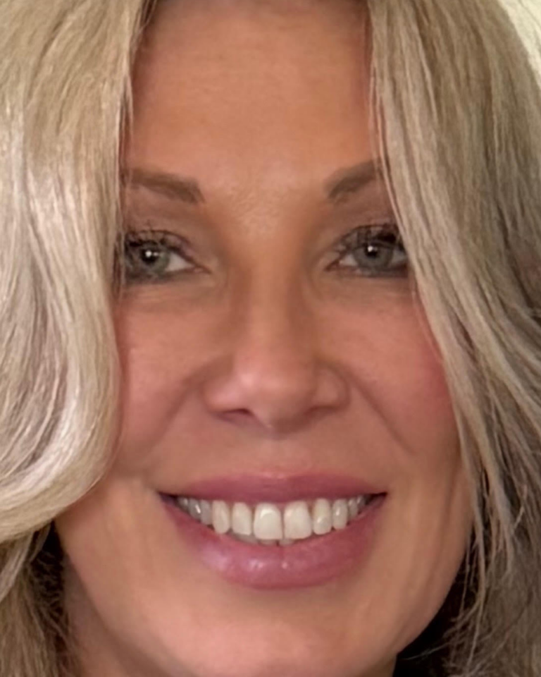 Patient - After Sculptra Treatment